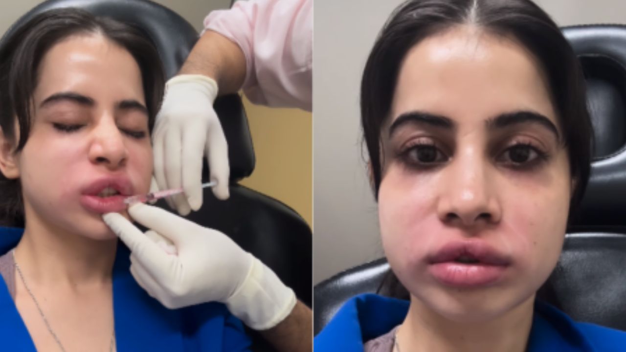 Urfi Javed lip filler removal